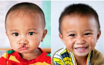 Operation Smile